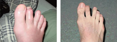 Gout toe