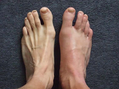 Gout toe of the foot