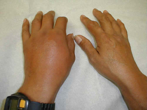 Gout: tophus