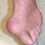 Gout toe